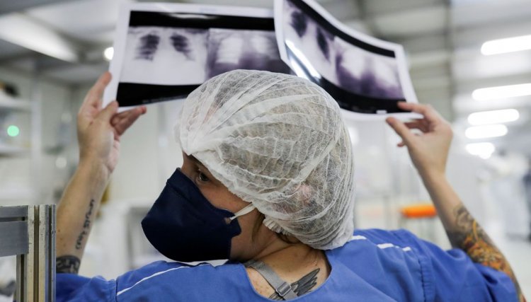 Médico alerta para riscos da tuberculose pulmonar não tratada