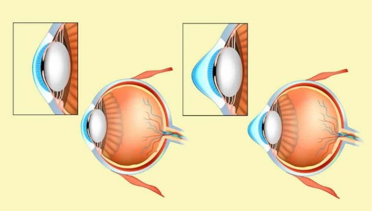 Ceratocone: O que é, Causas, Sintomas e Diagnóstico, você está em dia com seu exame de vista?