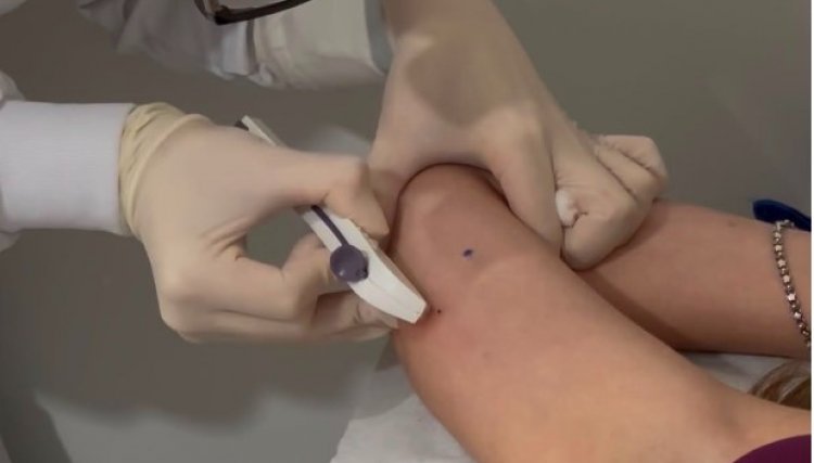 Corb&eacute;lia amplia acesso ao planejamento reprodutivo com oferta do Implanon pelo SUS