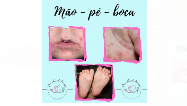 Você sabe o que é a síndrome mão-pé-boca (MPB)?