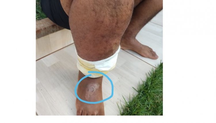 Cafelandense passa por três cirurgias após ser picado por aranha e pode ter que fazer outra nos próximos dias 