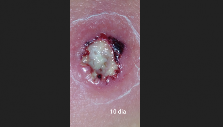 Após ser picada duas vezes por aranha peçonha morada de Nova Aurora faz alerta