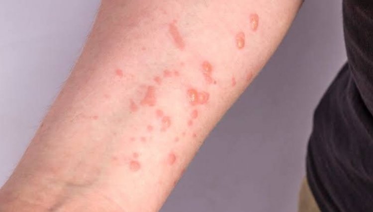 Terceiro caso de Monkeypox é registrado no município de Cascavel
