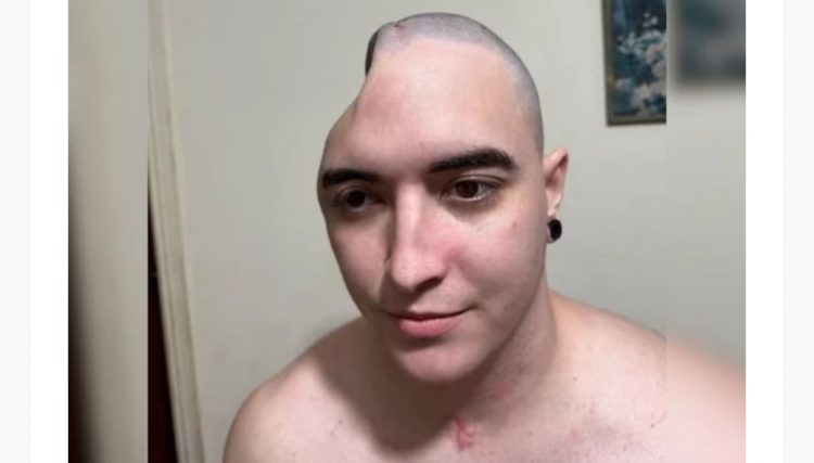 Jovem de Toledo ficou meses com parte do cr&acirc;nio �guardada� na barriga ap&oacute;s acidente