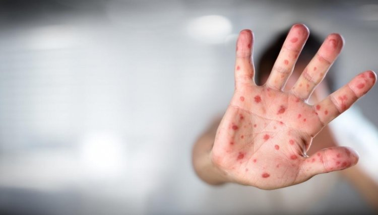 35 novos casos de sarampo são confirmados no PR somando 1.116 positivos