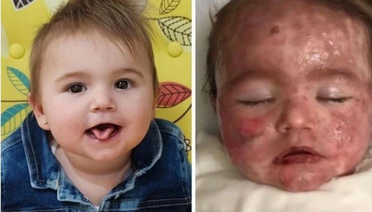 Bebê tem lesões em 72% do corpo após reação alérgica grave